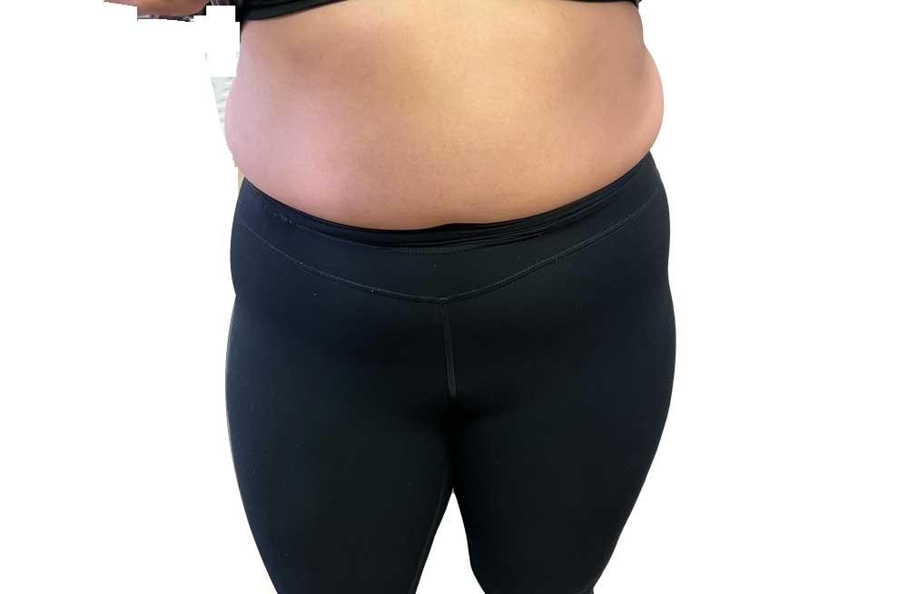 3月19日　マンジャロ2.5mg 11日目